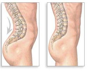 lordosis of the spine