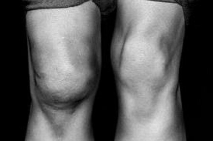 Knirschen die Knie beim Gewicht beim Kniebeugen