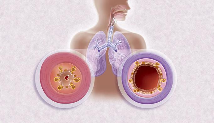 性阻塞性支气管炎症状和治疗