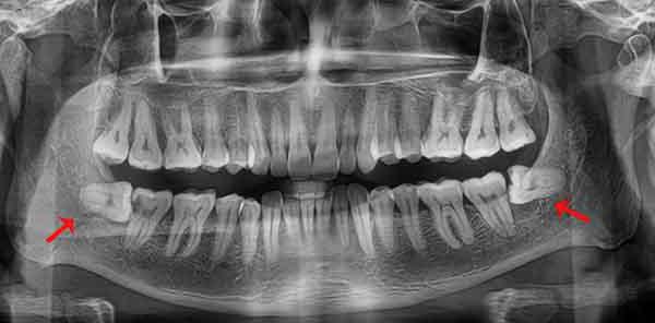 la eliminación del diente de la sabiduría en la mandíbula inferior de las consecuencias de la