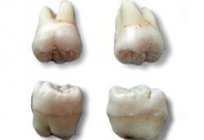 Видалення зуба мудрості на нижній щелепі: особливості, наслідки