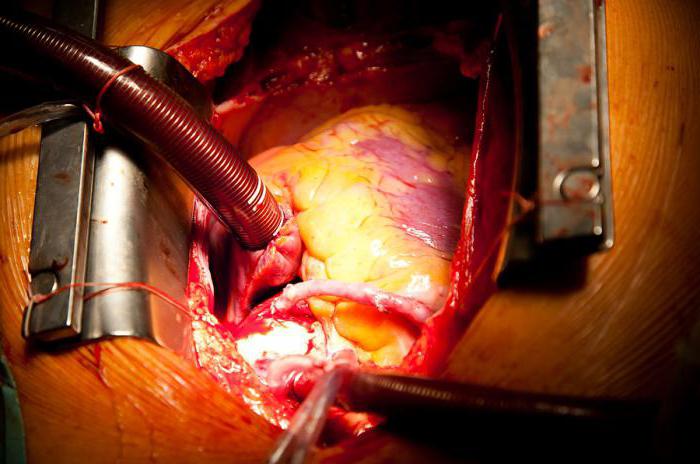 миксома serca operacja