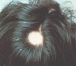 アスピリンのための髪の毛の成長