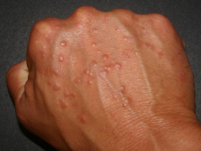 small transparent vesicles on the skin