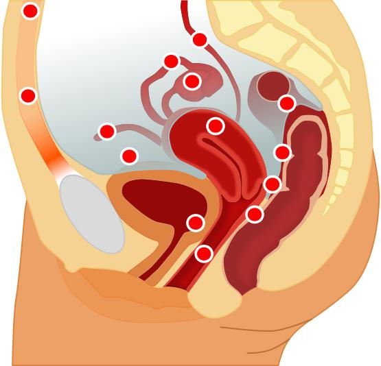 螺旋设的子宫内膜异位的评论，