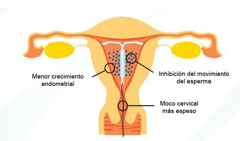 子宫内膜异位症的治疗与设螺旋