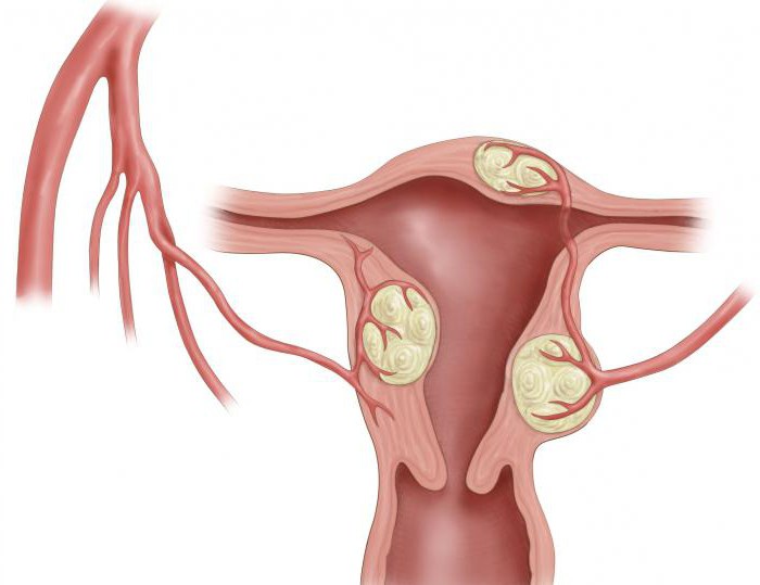 die Behandlung von Myomen des Uterus effektiv Volksmedizin