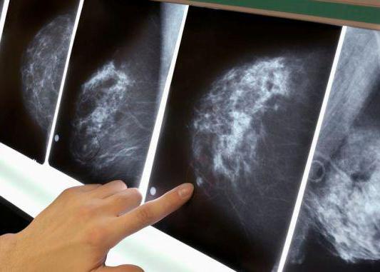 的乳房x光造影不同于乳腺超声