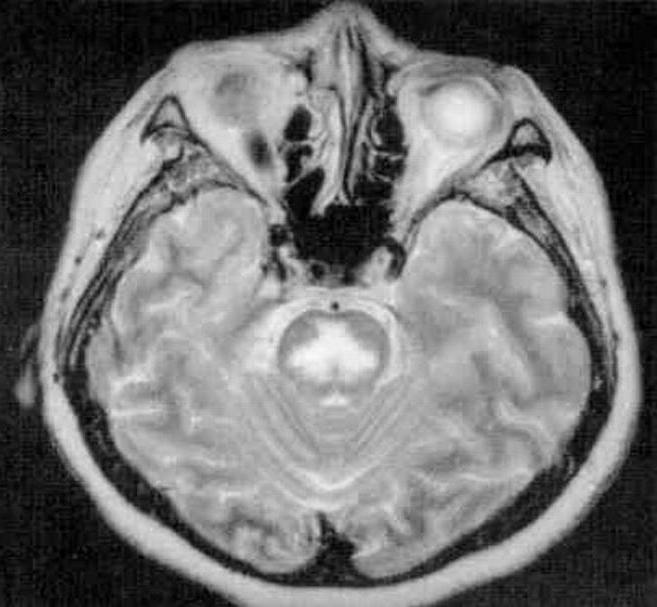 пухлина стовбура головного мозку у дітей