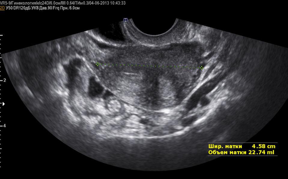 saddle-shaped uterus photo