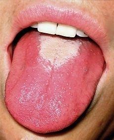 doenças da cavidade bucal tratamento