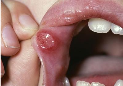 doença fúngica bucal tratamento