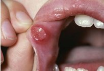 O que causa sensação de queimação da língua