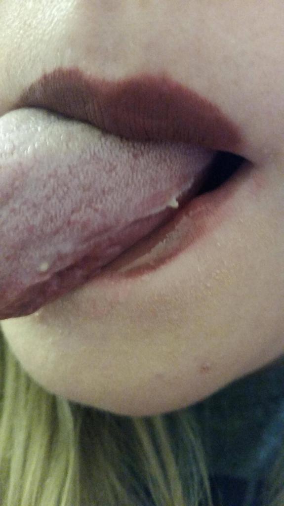 病と炎症の舌