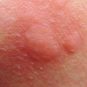 treatment of mosquito bites in children