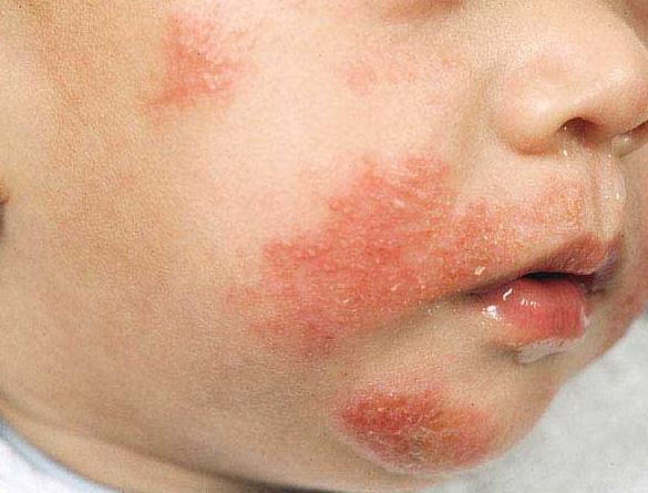 atopic dermatitis of the child