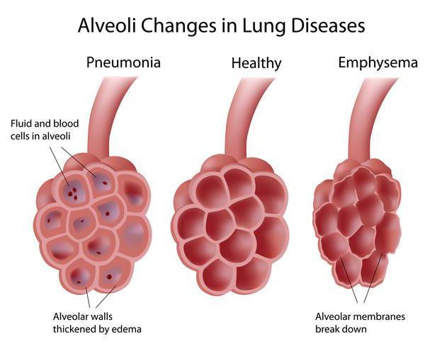 stadium zapalenia płuc