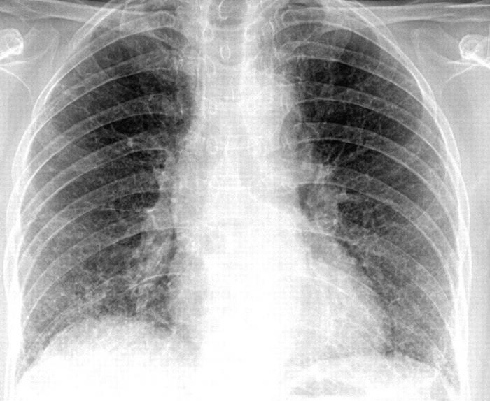 الالتهاب الرئوي x-ray