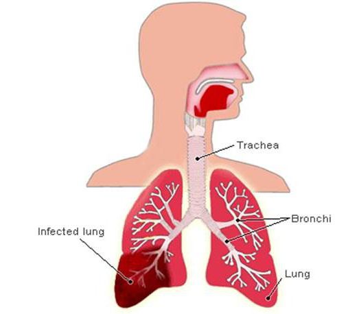 polysegmental pneumonia