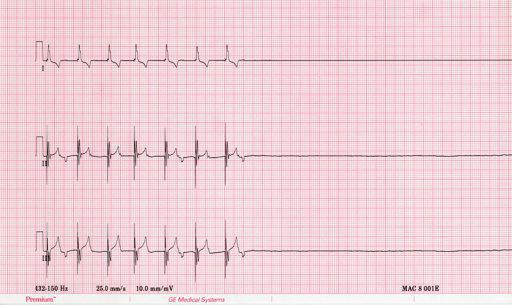 асистолия coração no ECG