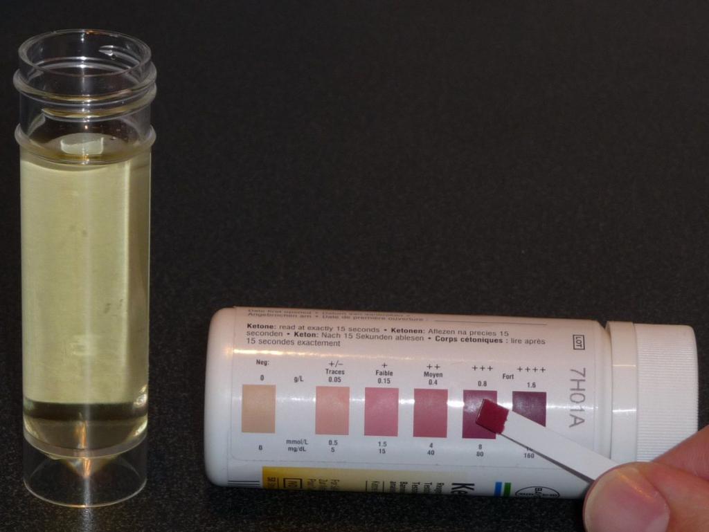 Acetone in the urine