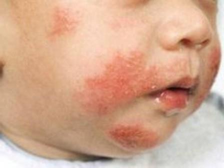 skin diseases in a child