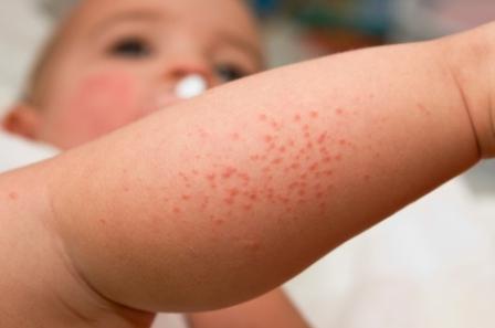 skin diseases in children symptoms