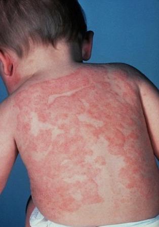 skin diseases in children photo