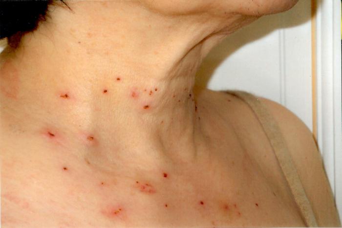 Papillomas गर्दन पर, कारण और उपचार