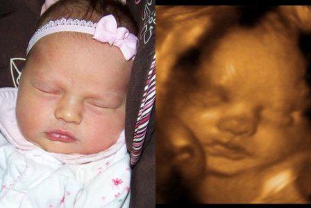 3D ultrasound pregnancy
