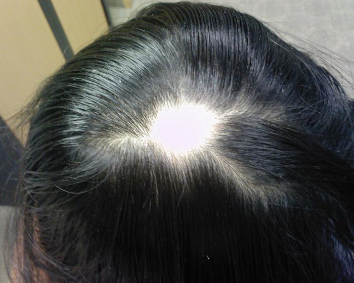 baldness in women causes treatment