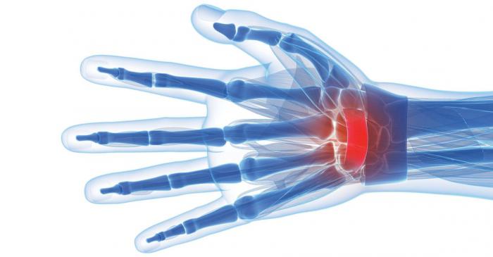 how to treat carpal tunnel syndrome