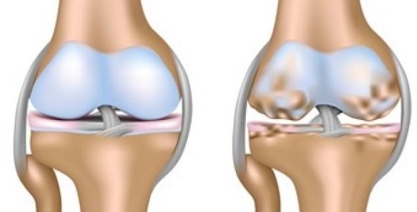 Gonarthrosis of the knee joint
