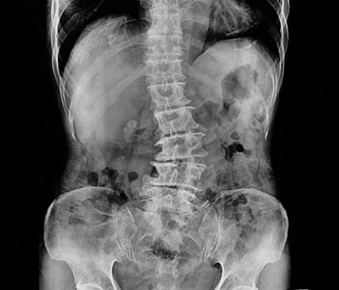 scoliotic deformity of the spine