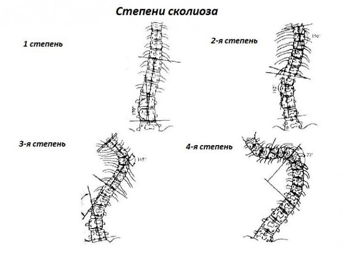 deformation of the lumbar spine