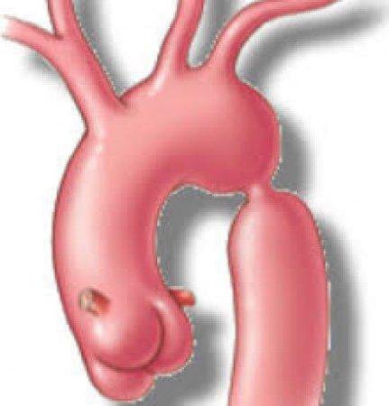 coarctation of the aorta is a