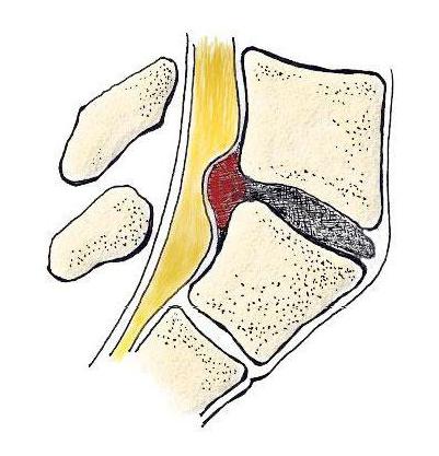 背椎间盘突出它是什么