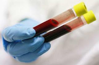 Alt和AST血液测试的成绩单