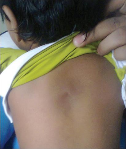 guza na plecach w pobliżu kręgosłupa zdjęcie leczenie