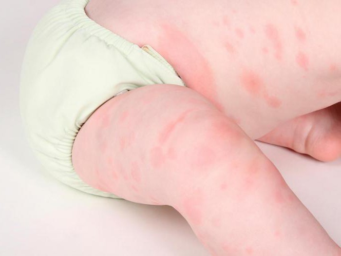 Alergia a glúten a criança tem sintomas foto