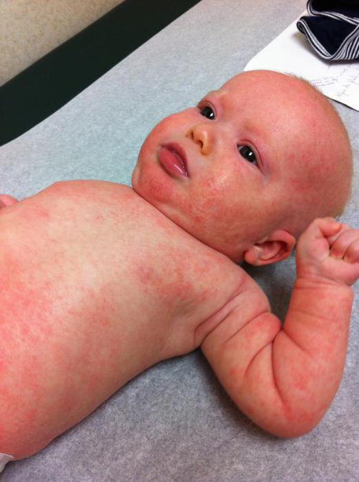Allergy to gluten symptoms in infants