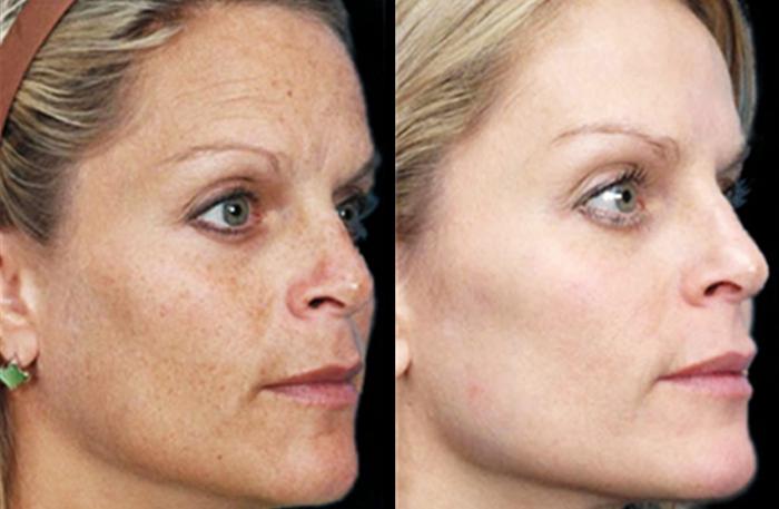 Laser facial rejuvenation testimonials
