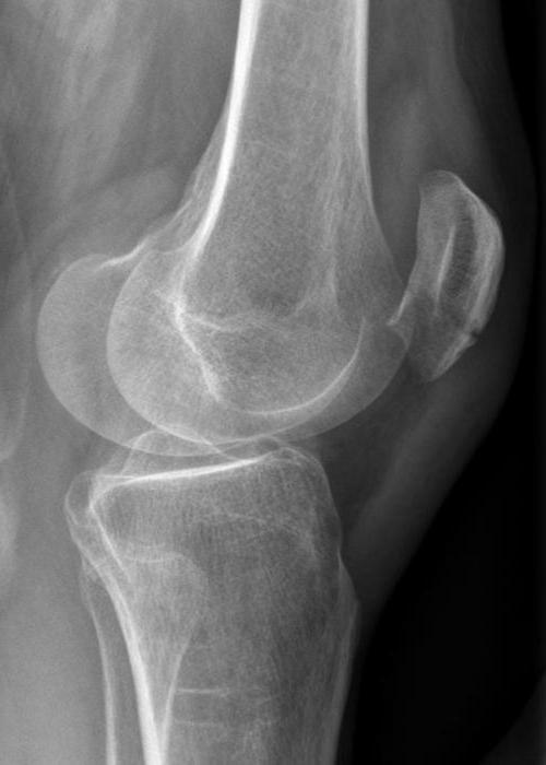 suprapatellar bursitisの膝関節症-治療