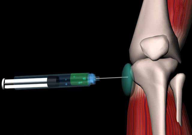 suprapatellar bursitis膝の治療の民間療法