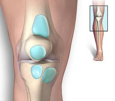 супрапателлярный bursite do joelho de tratamento