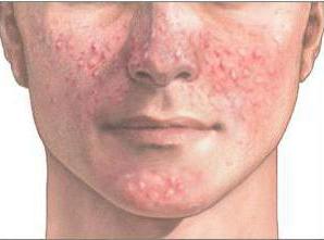 el acné en la cara por los organismos responden igual que curar