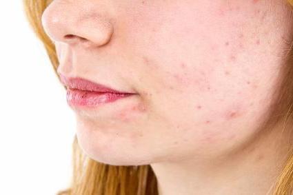 el acné en la cara por los organismos responden