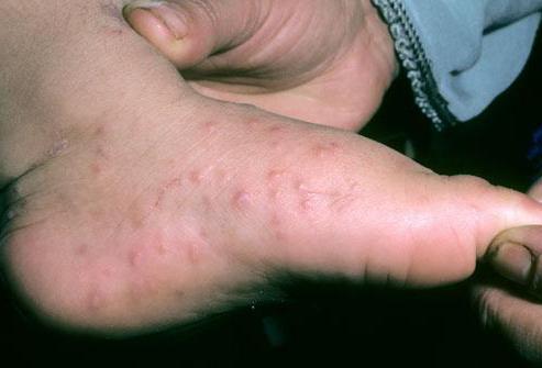 rash on the palms of the feet, the temperature treatment causes