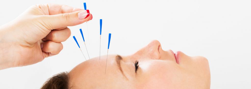 el Procedimiento de la acupuntura